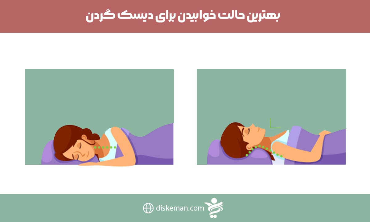 بهترین حالت خوابیدن برای دیسک گردن